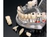 Fogászati állkapocsmodell implantátumokkal, 14 kivehető fog