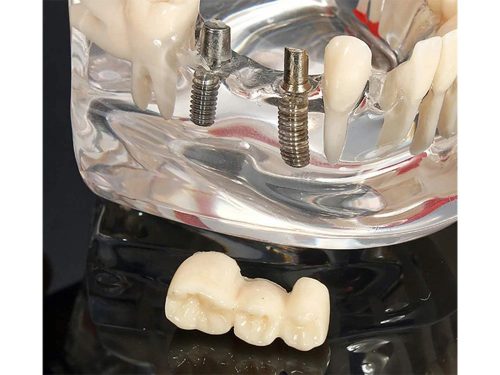 Fogászati állkapocsmodell implantátumokkal, 14 kivehető fog
