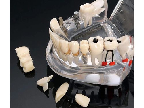 Implantátumos fogászati oktatómodell, 14 kivehető foggal